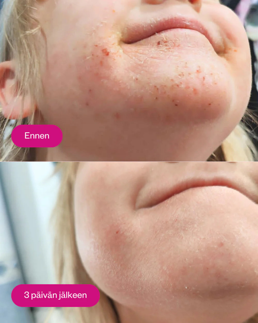 Propolis & Probiotics Rescue Cream erikoisvoide atooppiselle ja ongelmaiholle