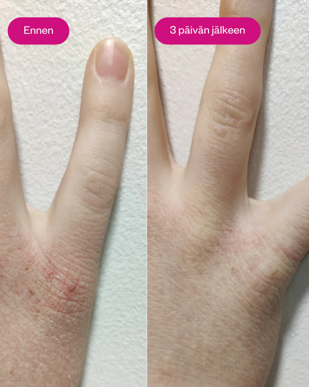 Propolis & Probiotics Rescue Cream erikoisvoide atooppiselle ja ongelmaiholle